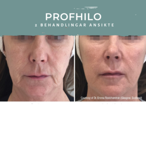 Profhilo före efter Nacka