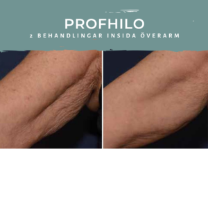 Profhilo Före Efter Nacka