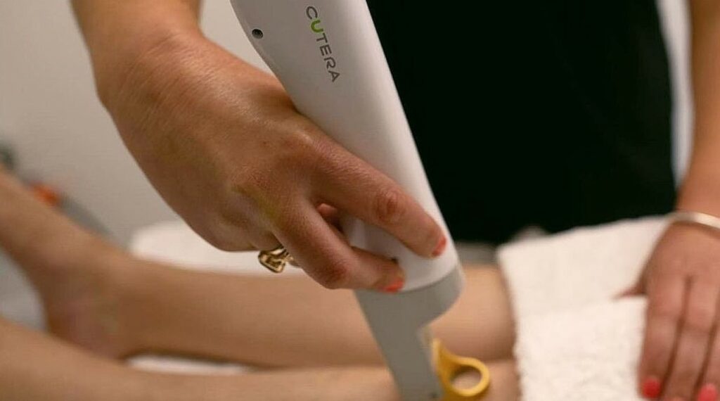 laser hårborttagning armhåla kärl cutera