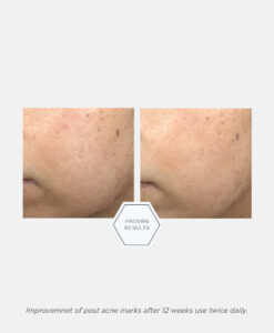Post-Acne Mark Correcting Serum. Före- och efter-bild